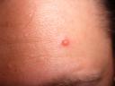 Pimple
